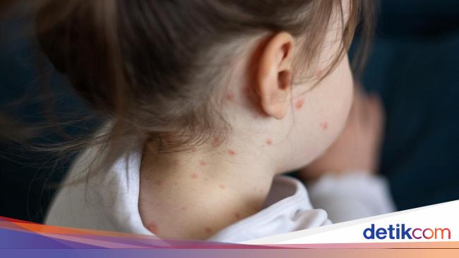 Kasus Suspek Campak Di Pohuwato Meningkat: Dinkes Gorontalo Soroti Rendahnya Imunisasi Anak Kasus Suspek Campak Di Pohuwato Meningkat: Dinkes Gorontalo Soroti Rendahnya Imunisasi Anak
