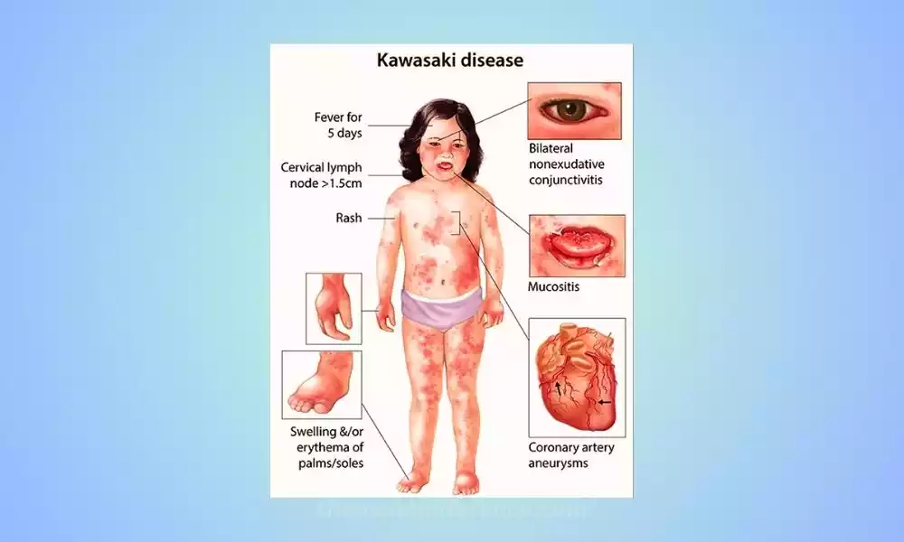 Kawasaki Disease: A Novel Respiratory Virus As The Culprit? Kawasaki Disease: A Novel Respiratory Virus As The Culprit?
