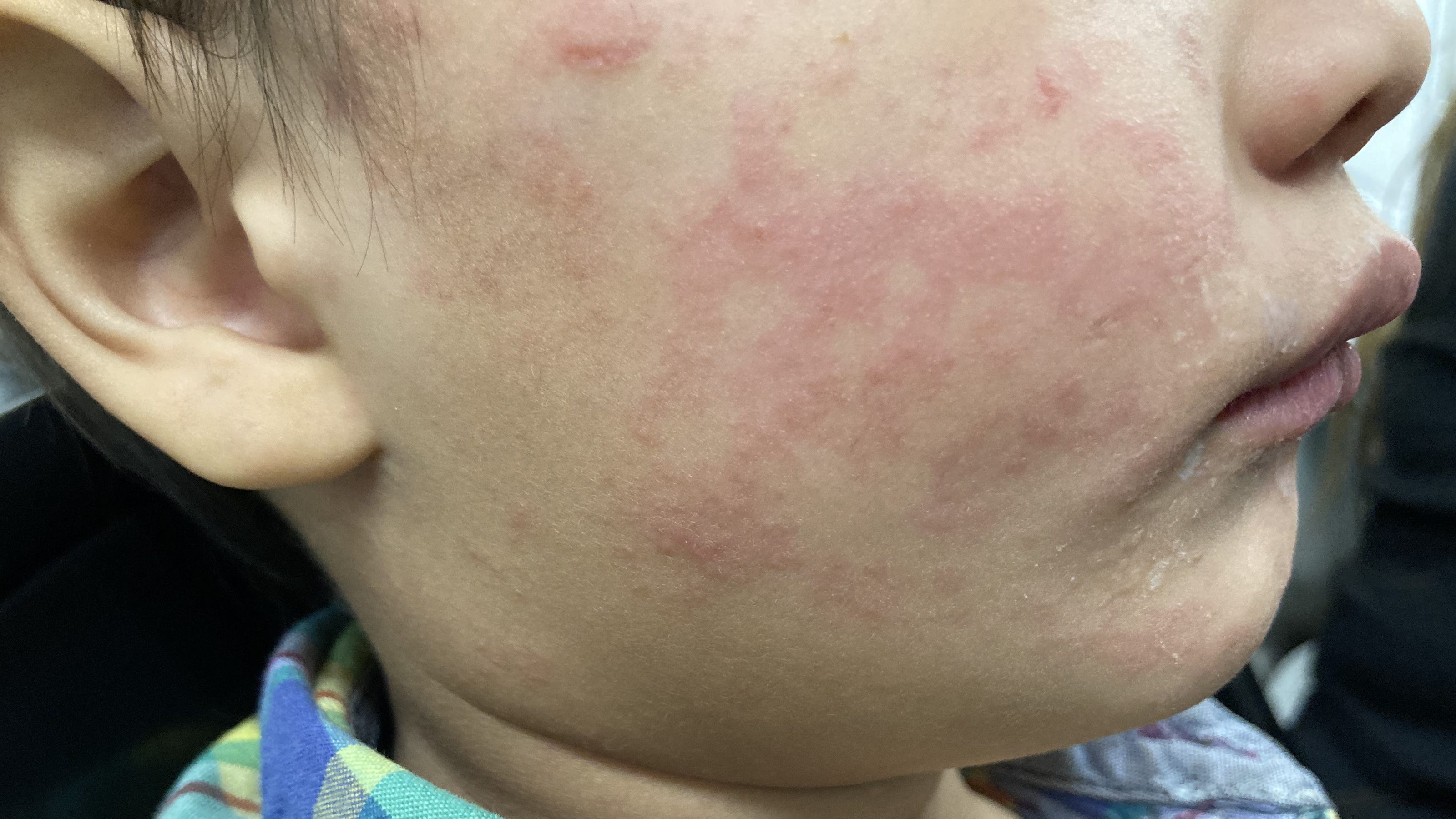 Measles In Texas: New Cases Reported, Separate From Current Outbreak Measles In Texas: New Cases Reported, Separate From Current Outbreak