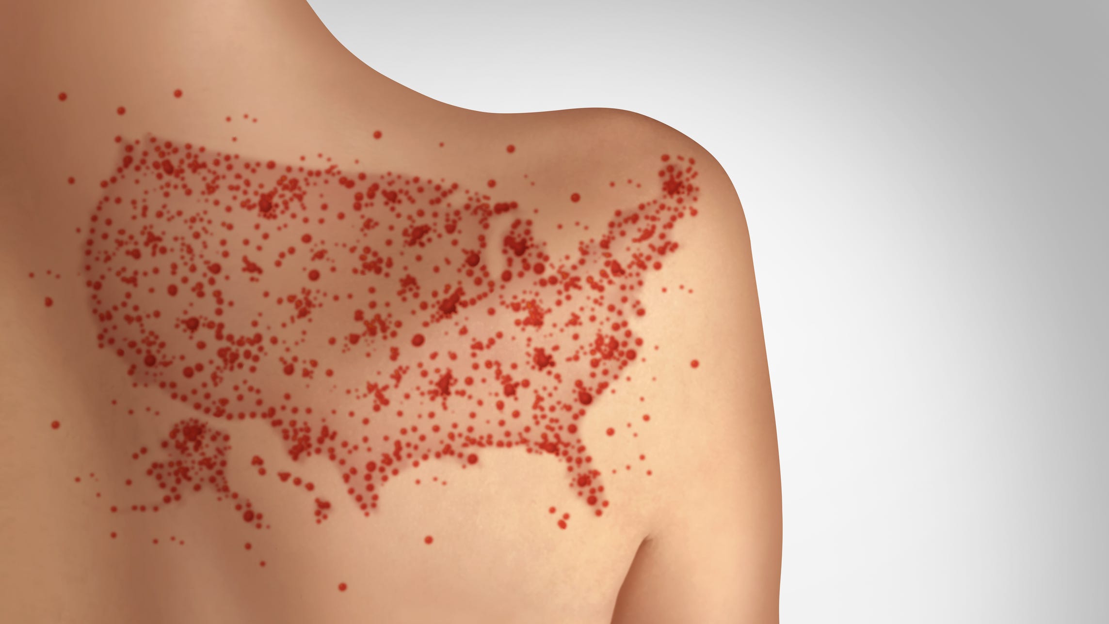Measles Outbreak Expands: Six New Cases Reported In Kansas Measles Outbreak Expands: Six New Cases Reported In Kansas