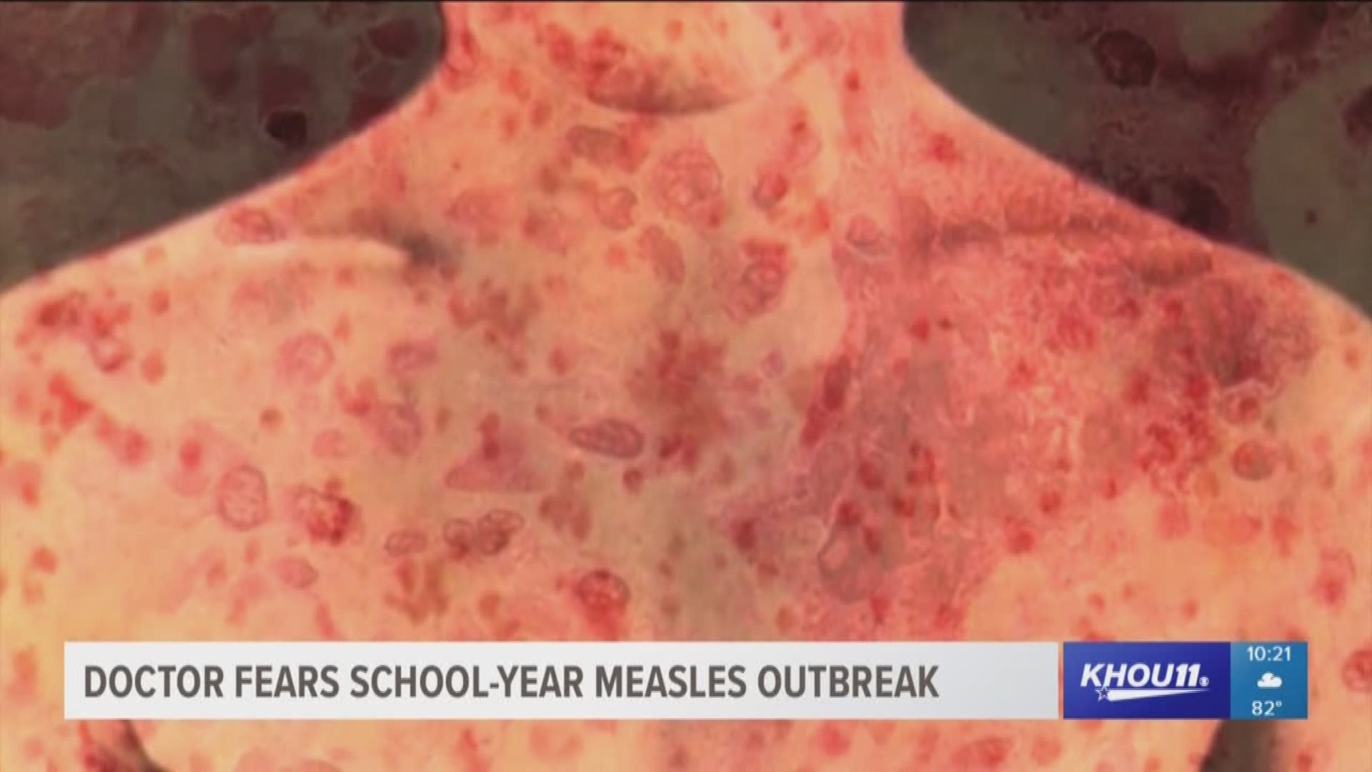 Measles Outbreak In North Dakota: School Quarantine For Unvaccinated Children Measles Outbreak In North Dakota: School Quarantine For Unvaccinated Children