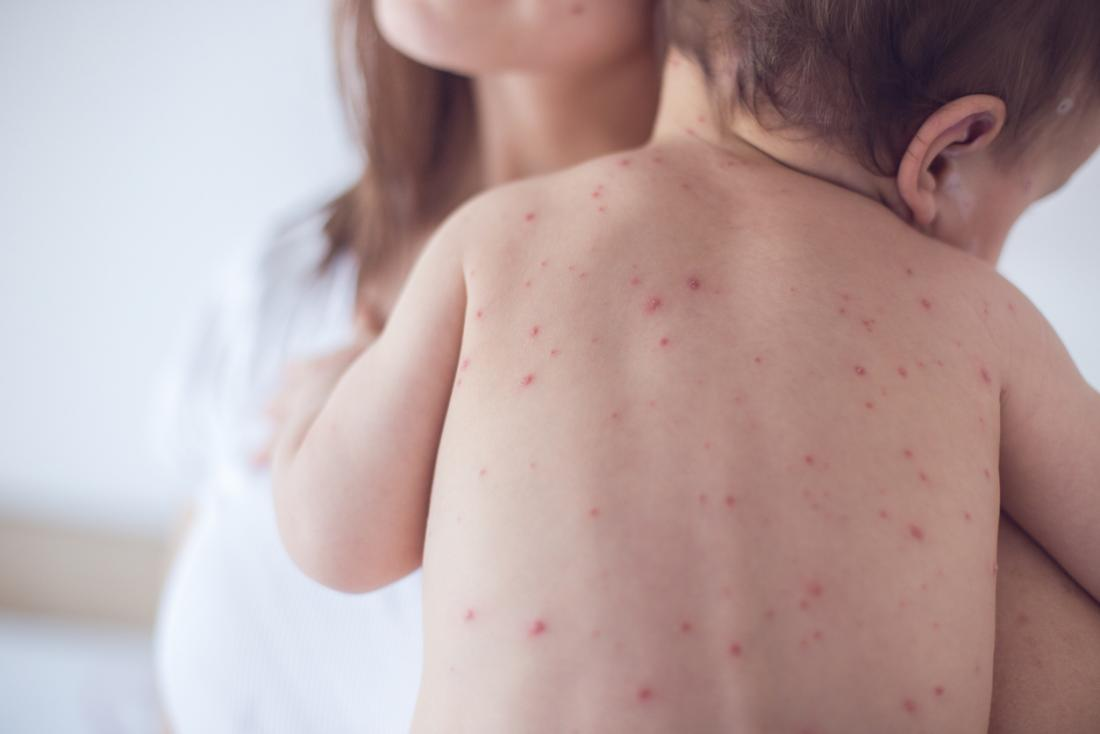 Six More Measles Cases Confirmed In Kansas: Public Health Officials Issue Warning Six More Measles Cases Confirmed In Kansas: Public Health Officials Issue Warning