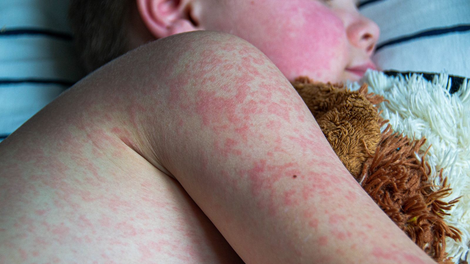 Virginia Confirms Second Measles Case This Year: Public Health Concerns Rise Virginia Confirms Second Measles Case This Year: Public Health Concerns Rise